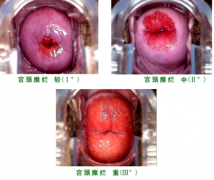 <b>女性宫颈糜烂如何治疗效果比较好</b>