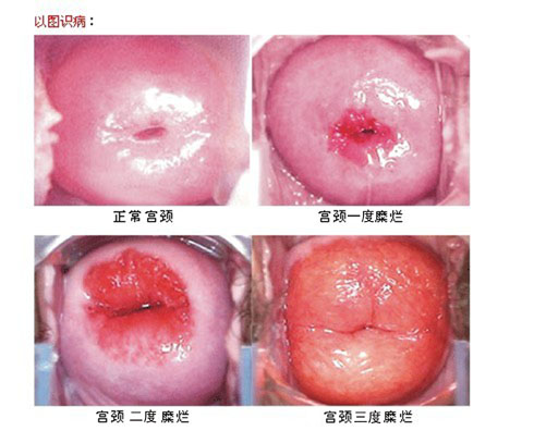 宫颈糜烂