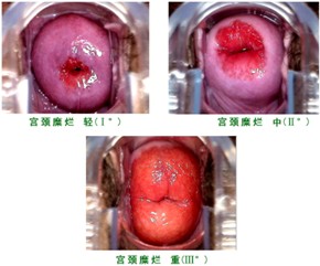 宫颈糜烂