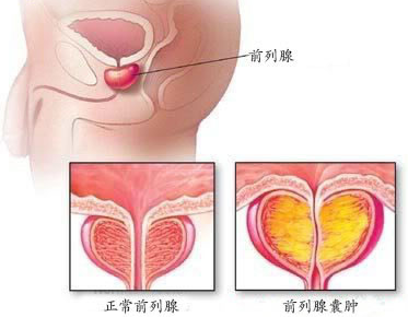 西宁男性前列腺囊肿需要多少钱