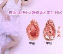 西宁做处女膜修复术安全吗