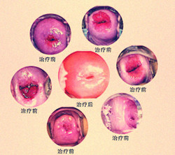 西宁宫颈糜烂的治疗