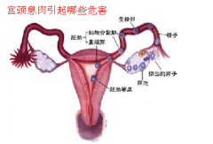 西宁女性宫颈息肉有哪些症状