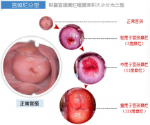 宫颈糜烂的症状有哪些