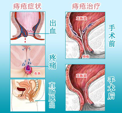 混合痔的表现是什么