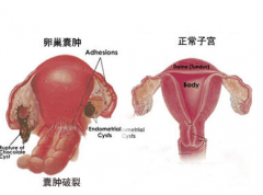 卵巢囊肿症状都有哪些？